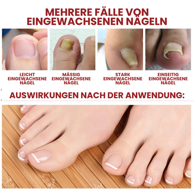 NailSoothe™ | Anti-Paronychie-Hilfsöl - 10ML (Jetzt 1+1 GRATIS)